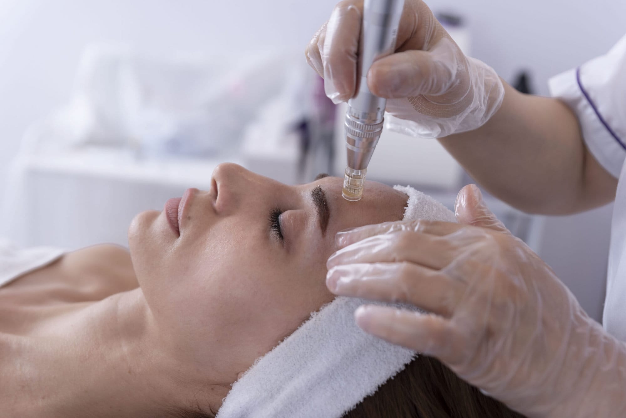 Skin Needling